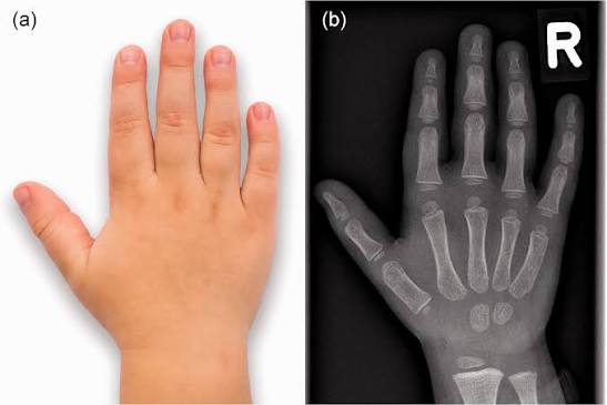 Your Child's Bone Age Is Advancing Too Fast? 6 Things You Can Do